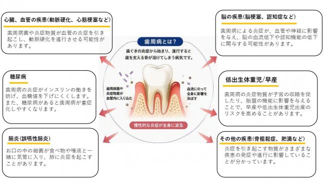 歯周病